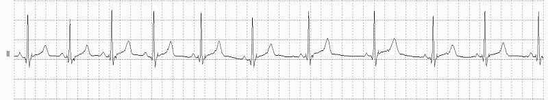 Sinus Arrhythmia Rhythm Strip